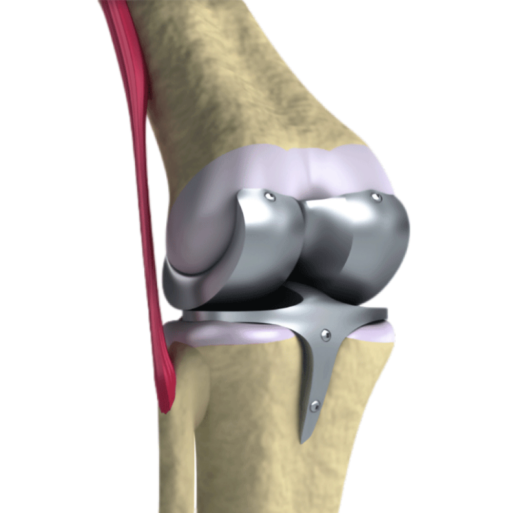 Knee-Replacement Knee-Replacement